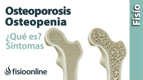 Osteoporosis Y Osteopenia Qué Es Causas Síntomas Y Tratamiento Youtube