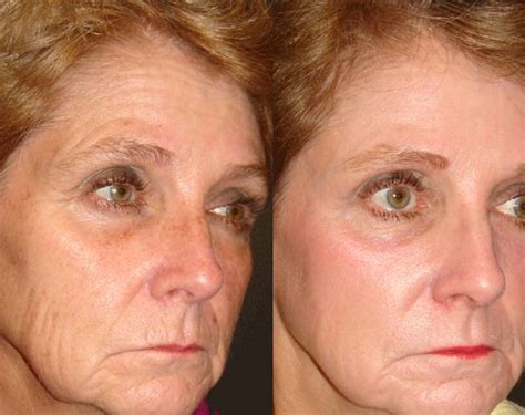 Fraxel Laser Treatment Before After Photos Joel Schlessinger Md