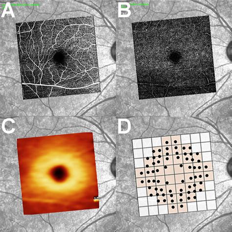 En Face Octa Images Of A An Svc B A Dvc And C An Oct Macular