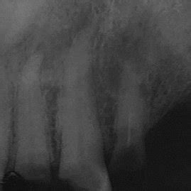 Cbct Image Showing An Impacted Palatal Placed And Inverted Mesiodens