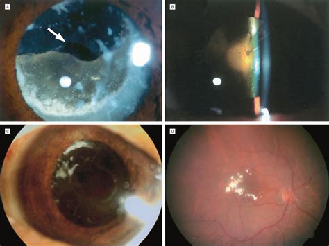 Morgagnian Cataract With An Isolated Posterior Capsular Opening