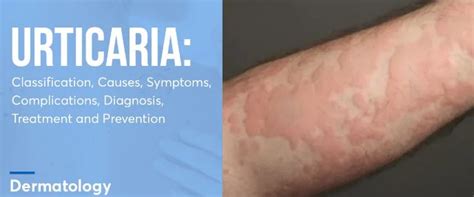 Homeopathy Treatment For Urticaria