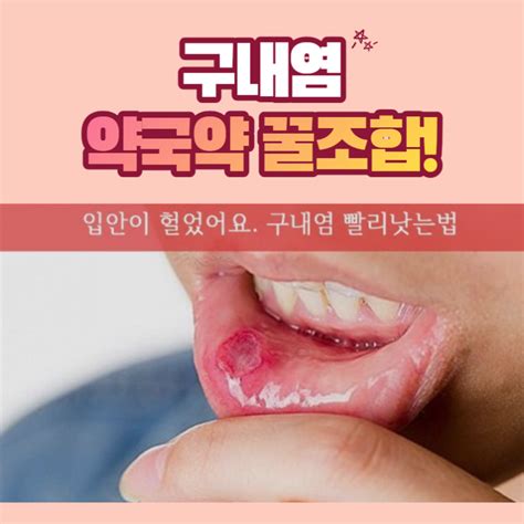 구내염 빨리 낫는법 약사님 좋은 구내염약 주세요 네이버 블로그