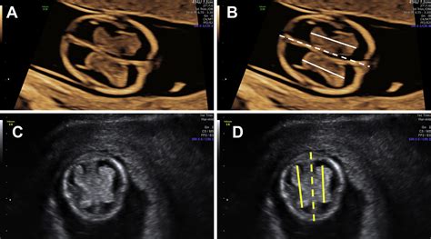 Diagnostic Accuracy Of Fetal Choroid Plexus Length To Head Biometry