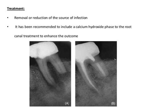 Root Resorption