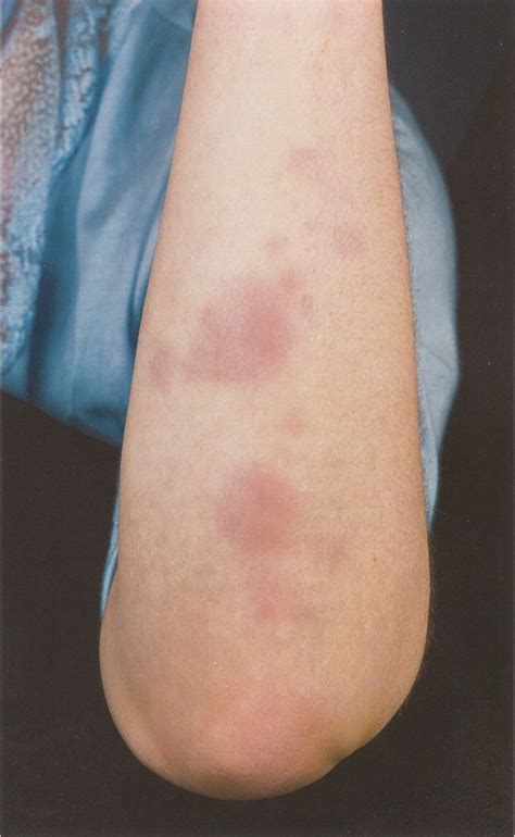 Erythema Nodosum