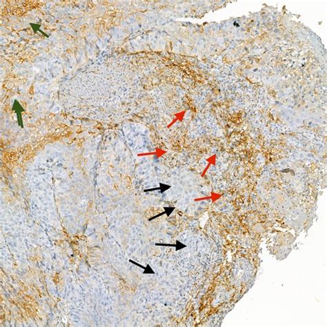 Immunohistochemical Staining Of PD L1 With Membranous Expression On