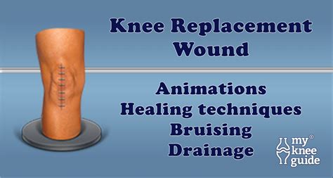 The Wound Important Considerations To Understand Knee Replacement