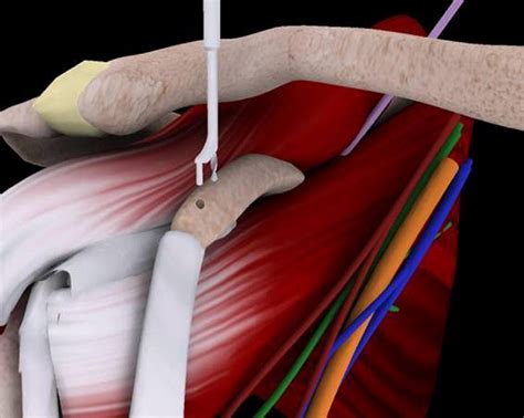 The Arthroscopic Latarjet Procedure For The Treatment Of Anterior