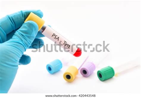 Blood Sample Psa Prostatespecific Antigen Test Stock Photo 420443548