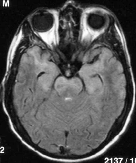 Axial Flair Mri Showing Diffuse Bilateral Frontotemporal Hypersignal Of Download Scientific