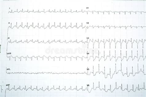 Electrocardiogram Test Results For Myocardial Ischemia Diagnosis Stock