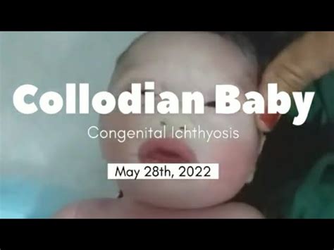 Congenital Ichthyosis