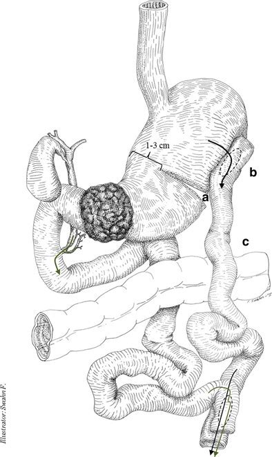 The Partial Stomach Partitioning Gastrojejunostomy Pspgj With