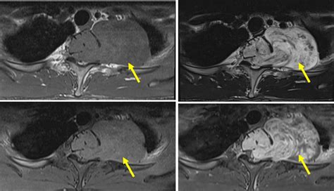 Spinal Schwannoma Radiology Cases