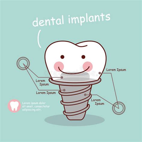 Cute Cartoon Tooth Implant Stock Vector Illustration Of Concept 67504539