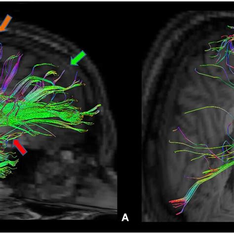 Amygdala Mri Sagittal