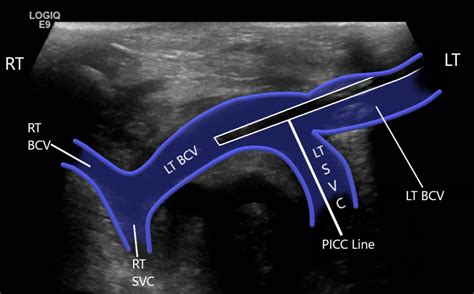 Upper Extremity Venous Doppler Sonographic Tendencies