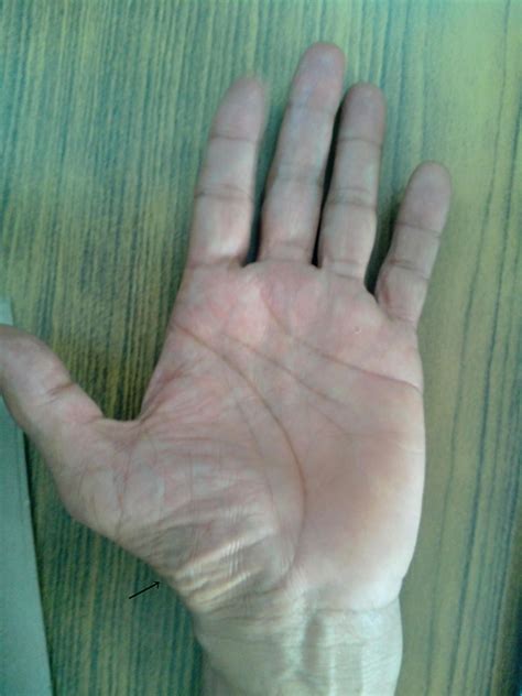 Amyotrophic lateral sclerosis presenting as typical split hand syndrome ...