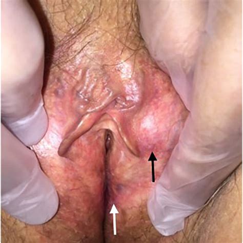 Genital Examination Vulva Shows White And Erythematous Patches On