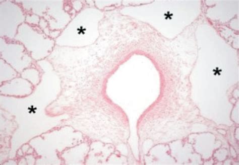 Radiographic Findings Flashcards Quizlet