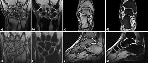 Synovitis Bone Oedema And Bone Erosions As Common Mri Findings On Download Scientific