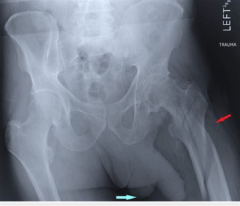 Anteroposterior Radiograph Of The Pelvis Demonstrating Leftsided Pelvic