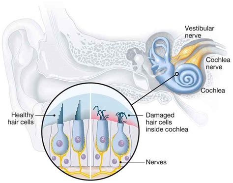 Sensorineural Hearing Loss: Causes, Symptoms, and Treatment