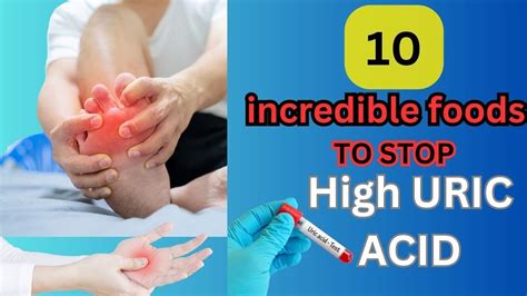 10 Incredible Foods To Lower High Uric Acid Levels Natural Remedies