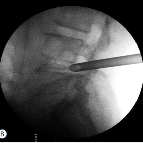 Pdf Endoscopic Spine Surgery