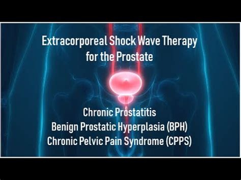 Extracorporeal Shock Wave For The Prostate YouTube