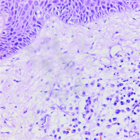 (PDF) Clinically granulomatous cheilitis with plasma cells