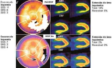 CINTILOGRAFIA CINTILOGRAFIA DE PERFUSÃO MIOCÁRDICA