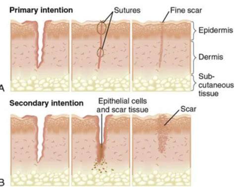 Wound Care Flashcards Quizlet