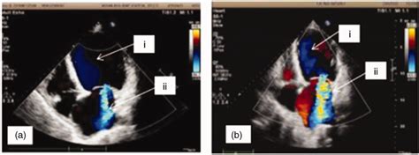 Echocardiography at two time points. (a) i. LVEDD and ESD were 74 and ...