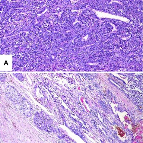 A Histological Findings From The Resected Tumor Specimen Showed A Solid