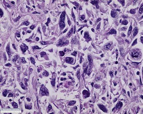 Metastatic Epithelioid Sarcoma In A Non Healing Ventricular Device