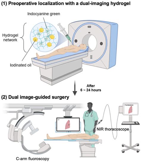 An Injectable Fluorescent And Iodinated Hydrogel For Preoperative