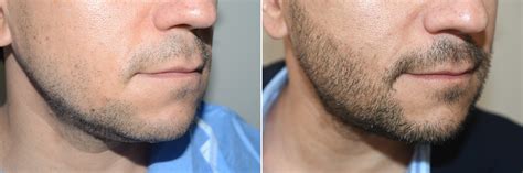 Facial Hair Transplant photos | Miami, FL | Patient125152