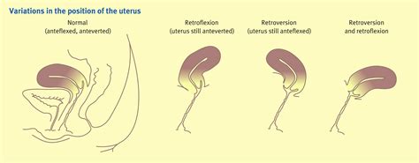 Anatomy Of The Uterus Anaesthesia And Intensive Care Medicine