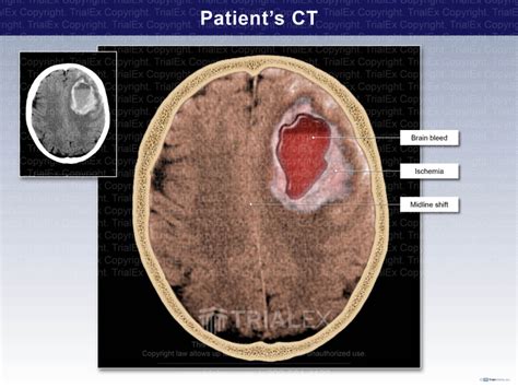 Hematoma Colorized Ct Scan Trialquest Inc