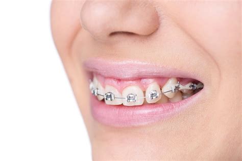 6 Benefits of Invisalign Braces over Traditional Braces for Cosmetic ...