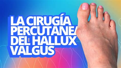 Cirugía percutánea del hallux valgus Dr Miguel Ángel Santana Reyna