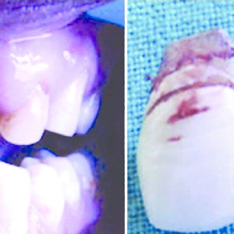 Fractured Anterior Maxillary Spine