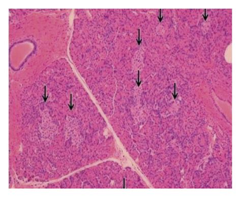 Immunohistochemical Staining For Chromogranin Highlighted Expanded