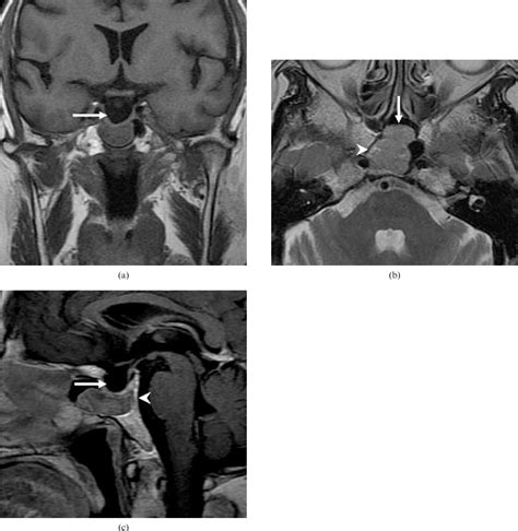 Figure 1 From Sphenoid Sinus Ectopic Pituitary Adenomas Ct And Mri