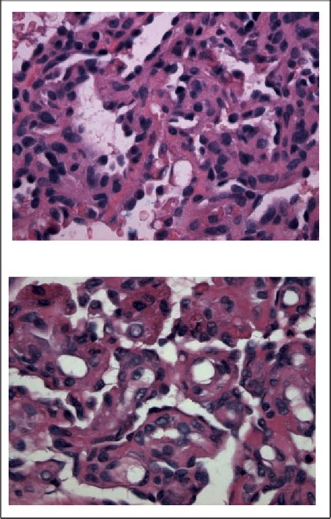 Figure 2 From Papillary Hemangiomas And Glomeruloid Hemangiomas Are