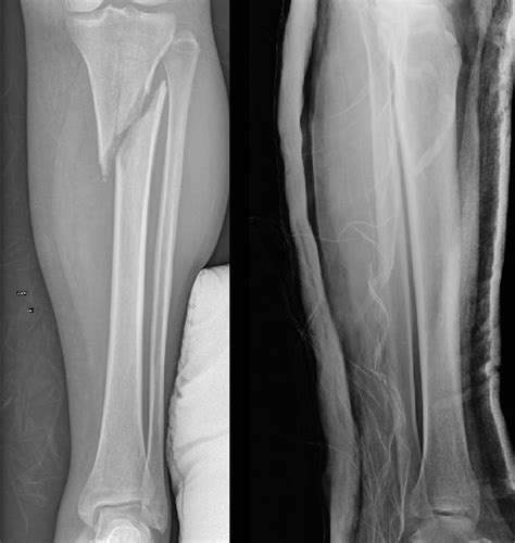 Tibia Shaft Fractures Trauma Orthobullets The Best Porn Website