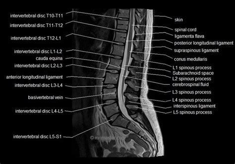 MRI lumbar spine sagittal cross sectional anatomy image 6 | Mri ...