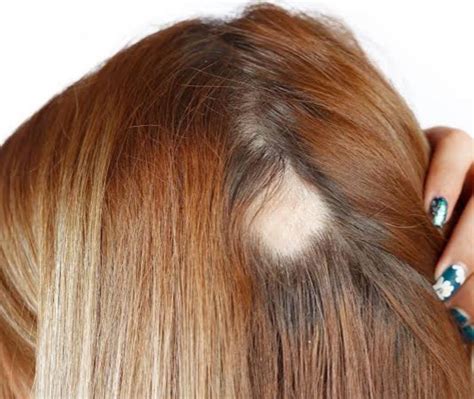 Você conhece os tipos de Alopecia Blog S ollér Brasil